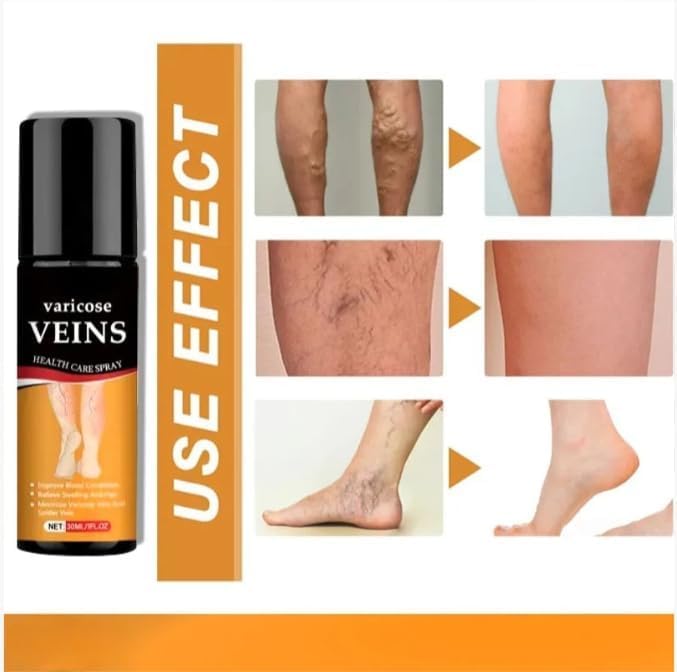 (Pack of 2) Varicose Veins Health Care Spray