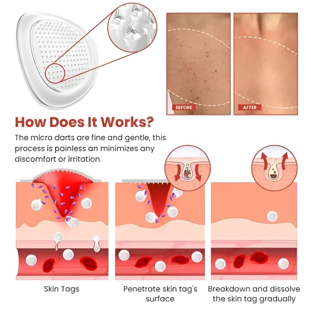 DermaSmooth Skin Care Patches – Gentle & Effective Skin Tag Remover for All Skin Types