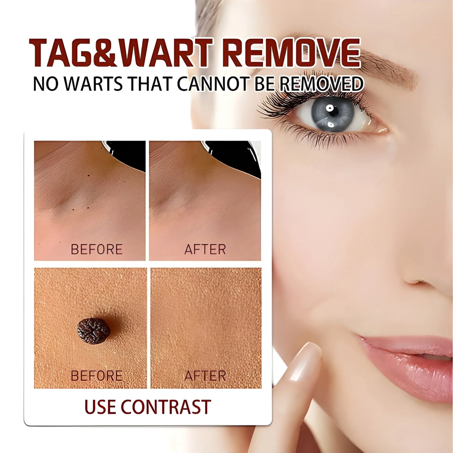 (Pack of 2) Lovilds Warts & Tags Remover Pen